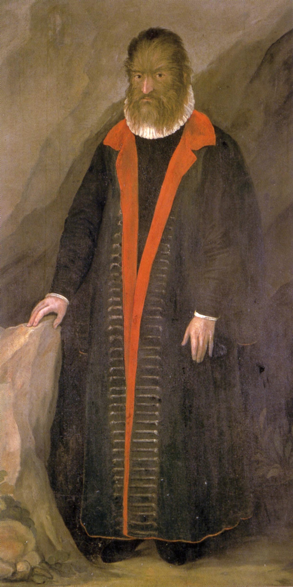 Petrus Gonsalvus urodził się pokryty włosami. Hipertrichoza – syndrom wilkołaka